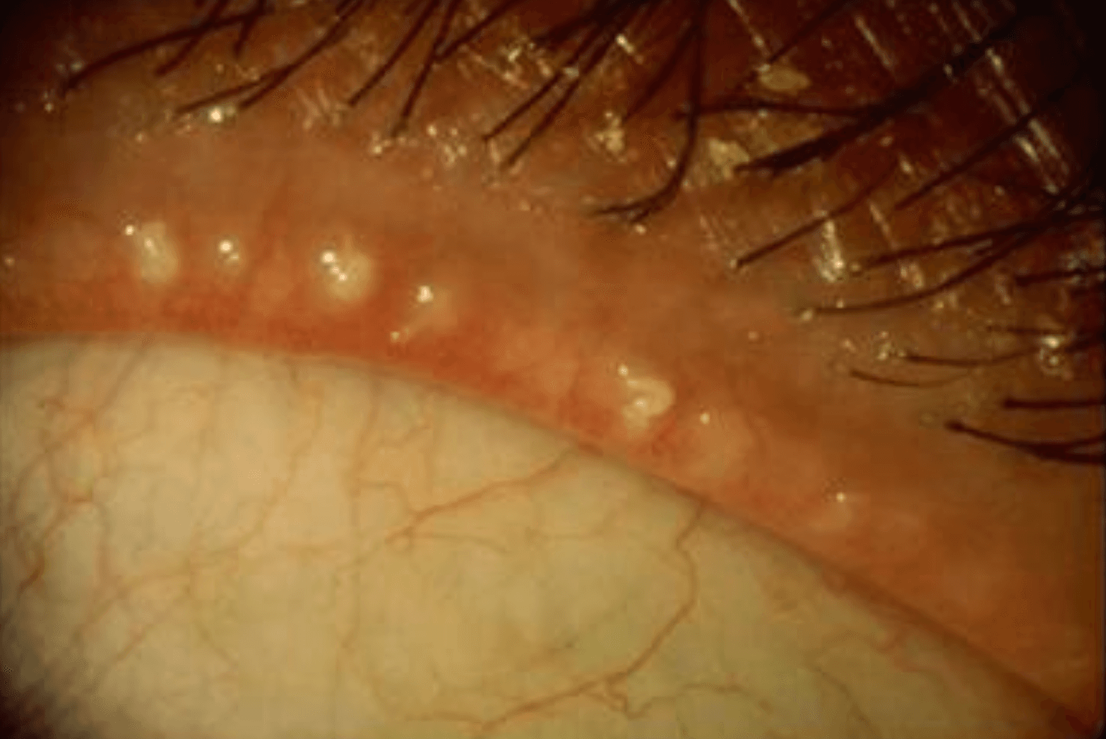 Close-up example of blocked meibomian glands