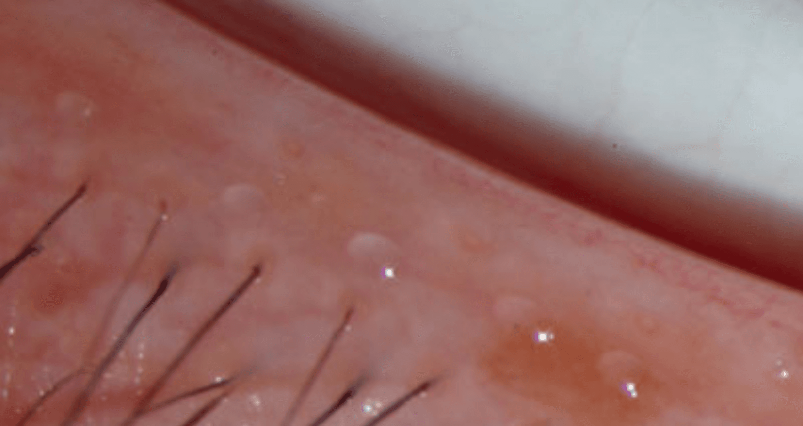 Close-up example of healthy meibomian glands