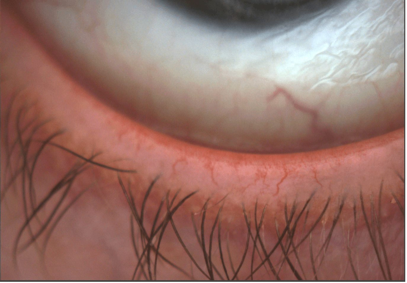 Dilated blood vessels along the eyelid margin