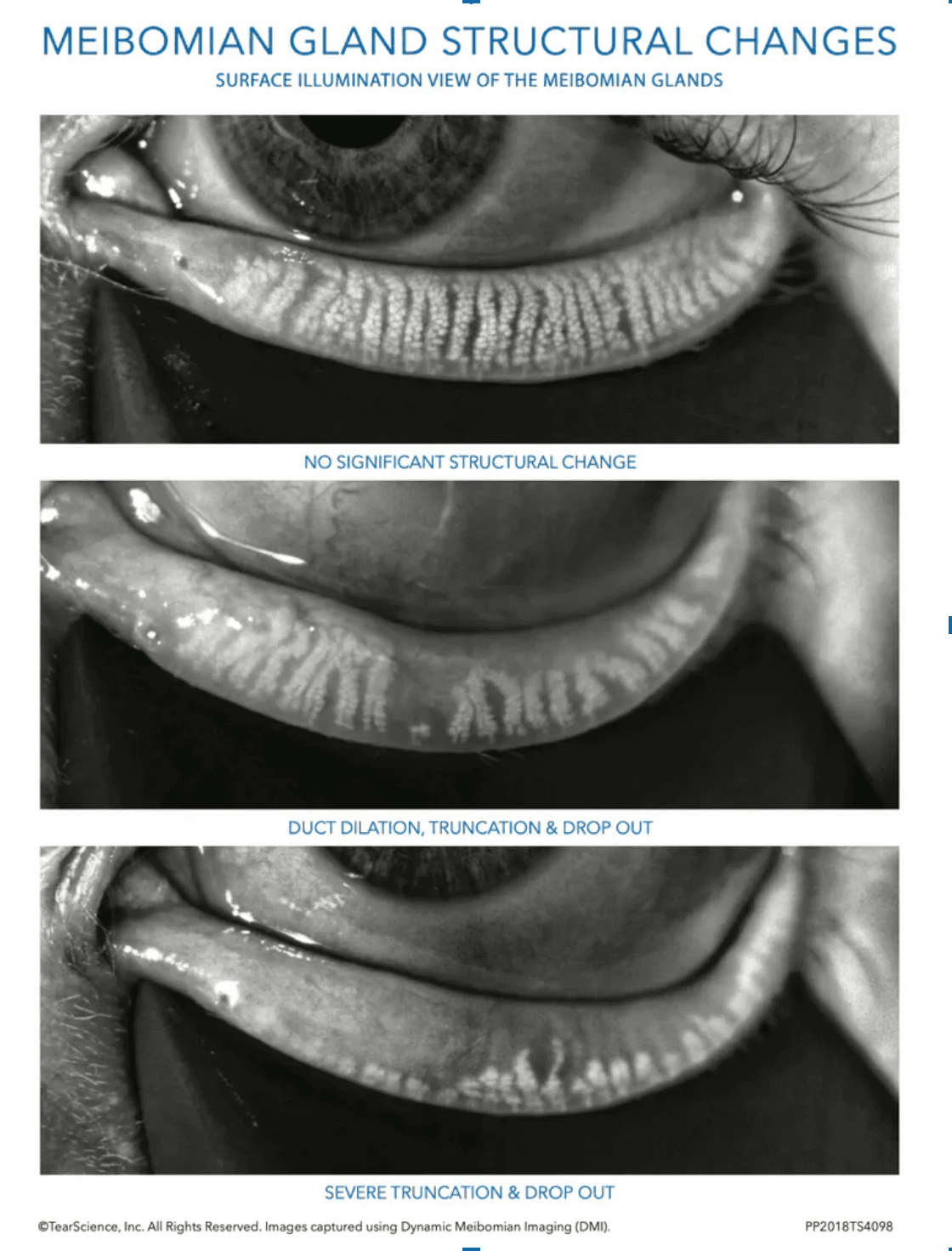Examples of meibomian gland structural changes