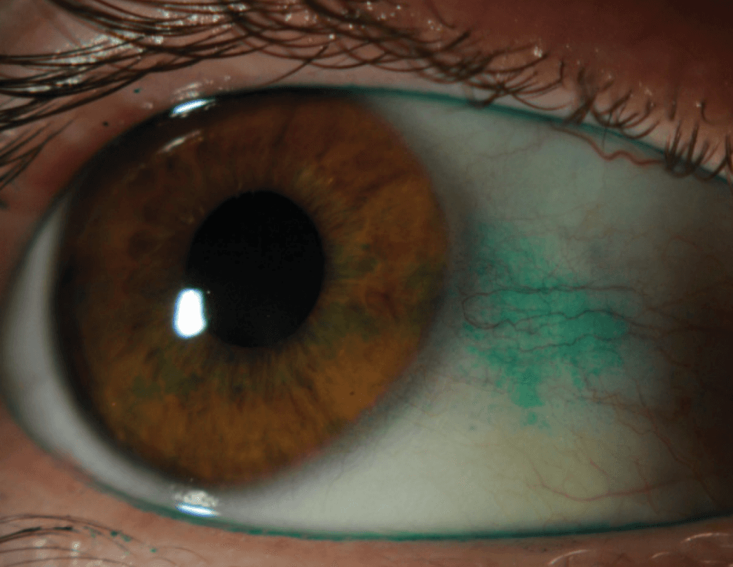 Ocular surface staining visible on an eye examination